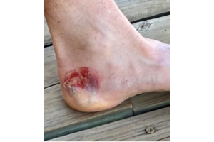 Blister on a heel